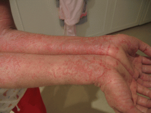 Eczema, Eczema treatment