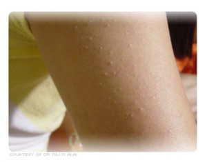 Keratosis Pilaris, skin disorder